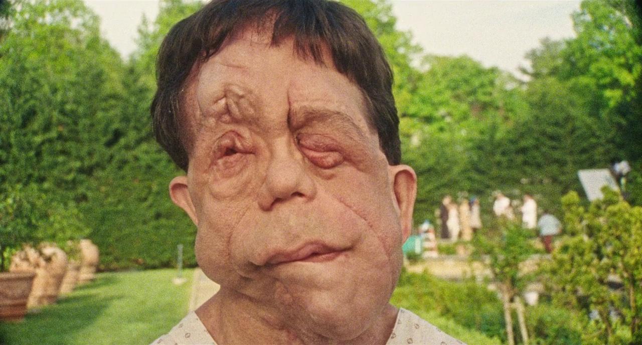 Still uit de film Chained for life. Portret van Rosenthal, die neurofibromatose heeft waardoor zijn gezicht misvormd is